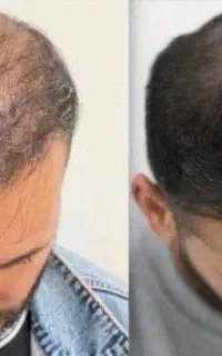 از در اومدن موهات نترس
