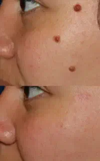جشنواره لیزربرداشتن خال و لیزرکک ومک باافر ویژه