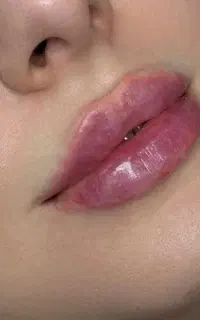 تخفیف استثنایی ژل لب،بوتاکس توسط پزشک