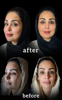 مرکز تخصصی تزریق چربی/بوتاکس/ژل لب لیفت شقیقه