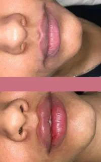فیلر،بوتاکس فیلرلب،و..درکلینیک تخصصی زیبایی