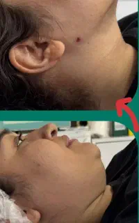 ساکشن غبغب تزریق چربی به صورت ۴/۵۰۰