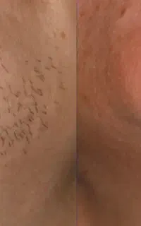 تنها کلینیک لیزر تضمینی موهای زائد بدن در سبزوار
