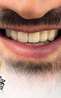 دندانپزشکی دیجیتال ایمپلنت اقساطی