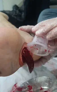 فصد سیاتیک ،برداشتن چربی زپوستی،حجامت مطب ومنزل