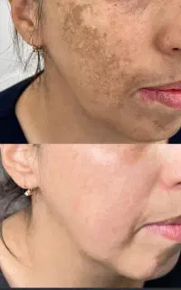 تخصصی ترین مرکزپوستی وزیبایی حذف تمامی لک هاکک مک