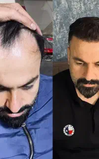 کاشت مو ابرو ریش با شرایط اقساطی
