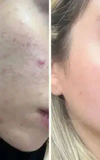 جوش داری جای جوش و تیرگی پوستت اینو ببین