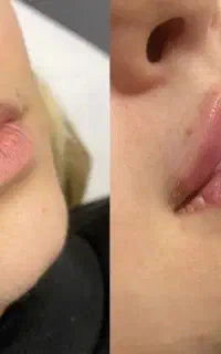 ژل و بوتاکس