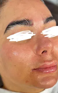 فیشال پوست