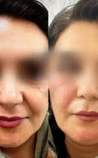 ساخت ژل جوان کننده پرکننده ازخون اولین بار دربوشهر