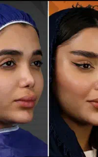 لیفت ابرو و شقیقه/دائمی و بدون بازگشت+اقساط