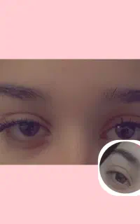 موخوره گیری کوتاهی مو ومژه