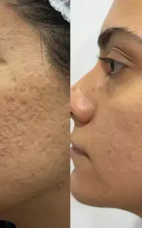 پوست شیشه‌ای با مزوژل