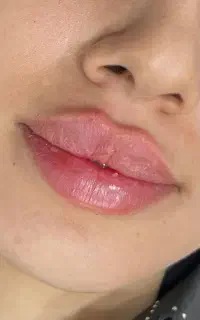 تخفیف ژل و بوتاکس توسط پزشک با قیمت استثنایی