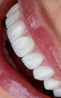 لمینت سرامیکی E.max - اقساط ۸ ماهه اصفهان