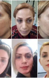 لیزرco2تک جلسه ای،تزریق چربی، دیگر خدمات زیبایی
