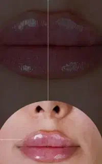 ژل و بوتاکس