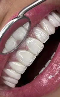لمینت، کامپوزیت و خدمات زیبایی دندانپزشکی