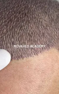 تخفیف ویژه/میکرو اسکالپ/مکمل کاشت/رفع کم پشتی