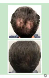 محلول موضعی رویش کاملاتضمینی