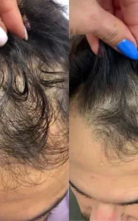 با ریزش موهات خداحافظی کن