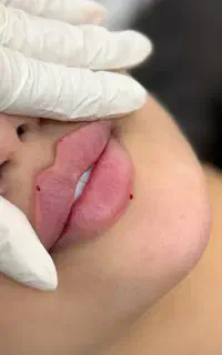 بوتاکس و فیلر و بلفاروپلاستی، لابیاپلاستی