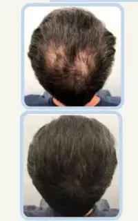 کاشت بدرد نمیخوره
