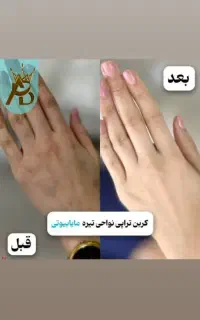 روشن شدن صورت و بدن با کربن تراپی مایابیوتی