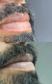 فیبروزابروی آقایان ورفع کبودی لب اقایان اقساط4ماهه
