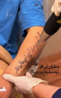 لیزر حذف تاتو-تتو/کربن تراپی/کربوکسی تراپی