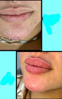 تزریق ژل وفیلر و بوتاکس و جوانساز  انزیم وچالگونه