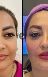 فیلربوتاکس لیزر فیشیال پاکسازی