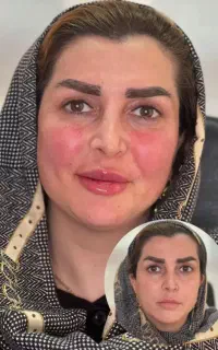 ساکشن غبغب،بلفاروپلاستی،فول فیس،هیپ دیپ