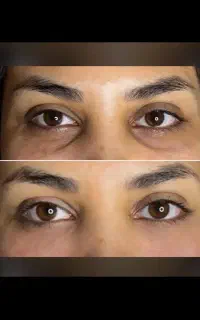خدمات زیبایی / اصلاح فرم بینی / گودی زیر چشم