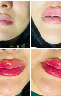 فیلرلب چابهار