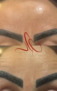 تمدید تخفیف ۳۰ درصدی بوتاکس ۱/۹۸۰/۰۰۰