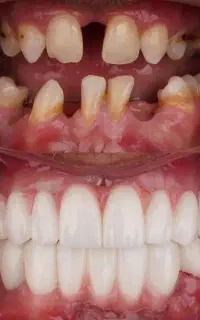 تخفیف ویژه ایمپلنت دیجیتال و اوردنچر به مدت محدود