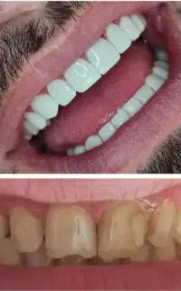 تخفیف ویژه کامپوزیت از فکی ۱۰۵۰۰ تا ۱۵ عصب کشی۲۵۰۰