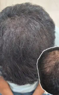 مکمل کاشت مو / میکرواسکالپ