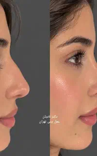عمل بینی به قیمت سال گذشته در تهران