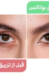 مدل برای بوتاکس