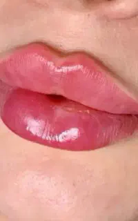 جشنواره ۵۰٪تخفیفی تابستانی فیلر و بوتاکس