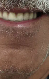 ساخت   دندان مصنوعی و نایت گارد