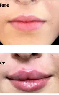 تزریق فیلر و بوتاکس