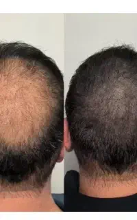 میکرو اسکالپ سر، کاشت مو غیر تهاجمی،میکرواسکالپ