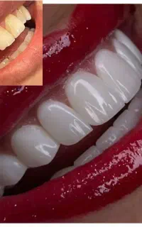 کامپوزیت لمینت روکش