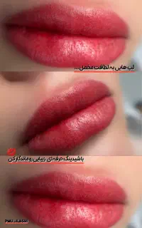 شیدلب، شیدینگ لب رفع کبودی لب به صورت تخصصی تضمینی