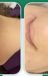 الکترولیز مو زائد،حذف دائم تضمینی