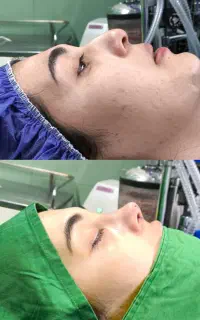 عمل جراحی با تکنیک segگذاری